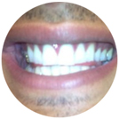 "Meine Zähne wurden fast zu weiß"